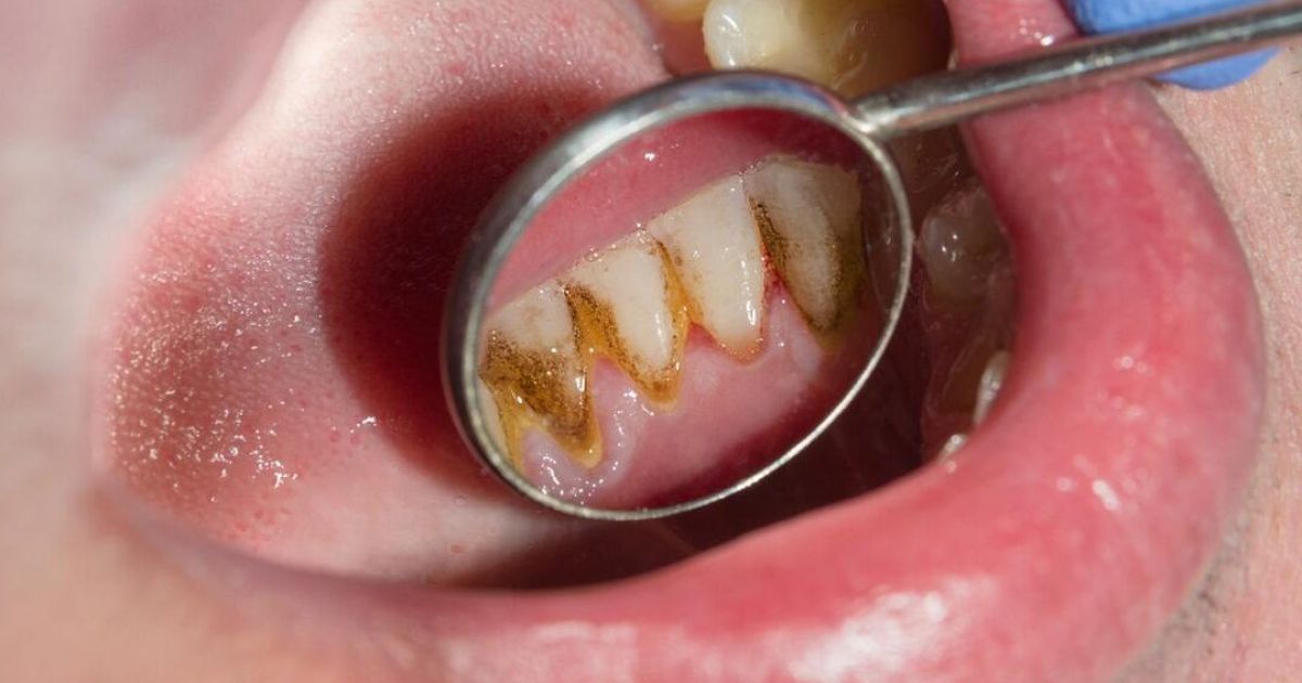 5 Cara Efektif Mencegah Karang Gigi dan Menjaga Kesehatan Mulut