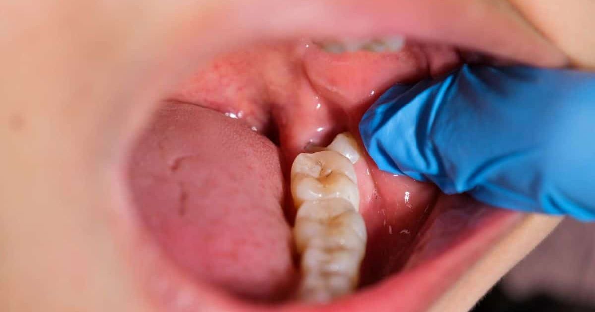 Apakah Gigi Geraham Bisa Tumbuh Kembali? Simak Fakta dan Solusi Medisnya