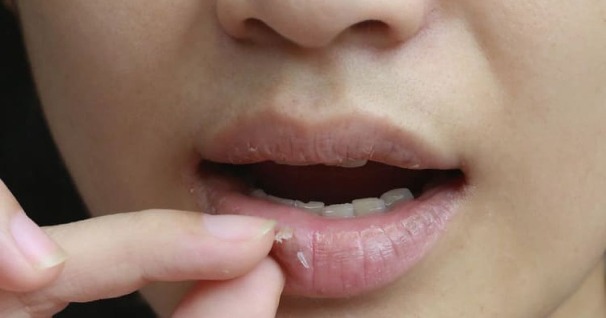 Bukan Sekadar Cuaca Panas, Kenali Penyebab dan Cara Atasi Bibir Pecah-Pecah