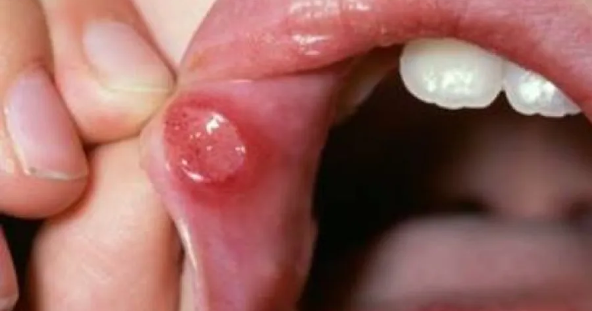 Kenali Penyebab Sariawan, Gejala, dan Perbedaannya dengan Herpes Oral
