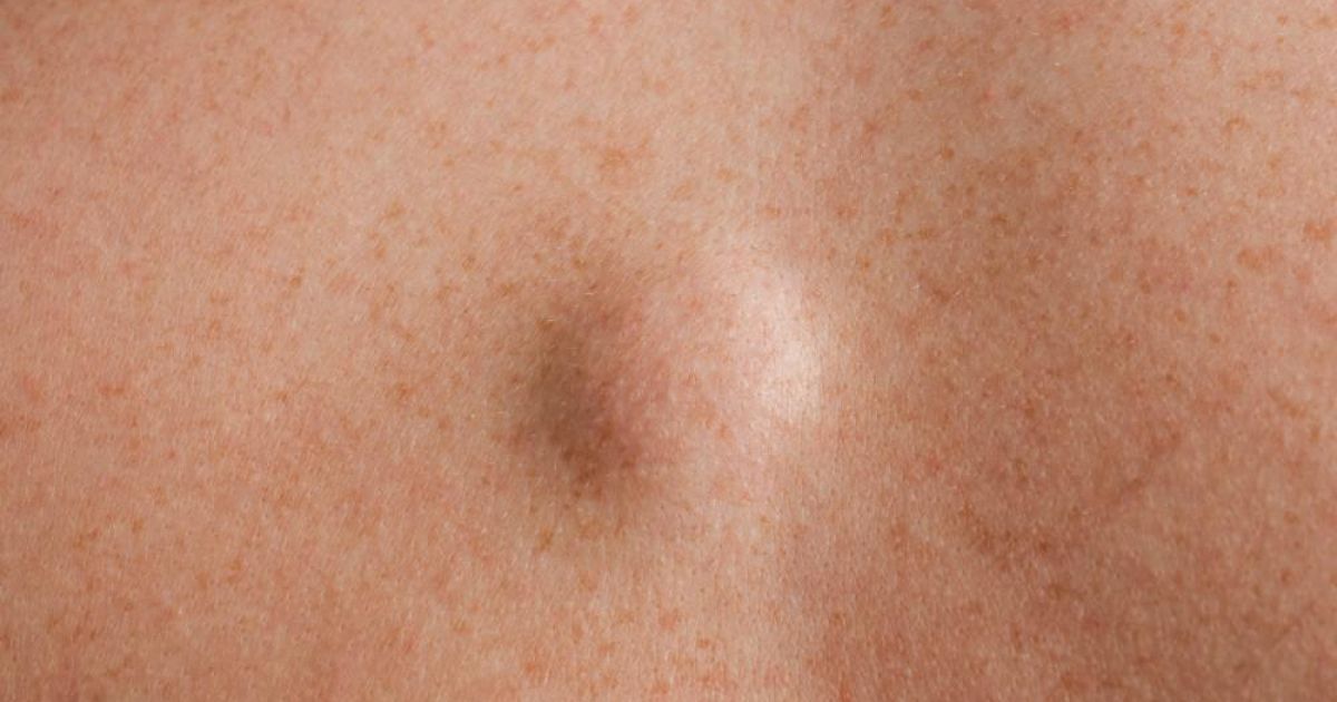 Benjolan di Punggung: Kenali Penyebab, Gejala, dan Cara Penanganannya