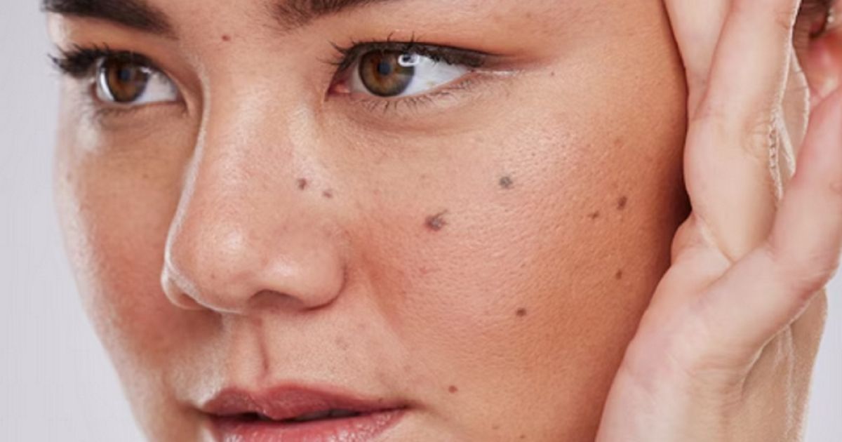 Mengenal Tahi Lalat: Penyebab, Faktor Risiko, dan Tanda Bahaya Melanoma