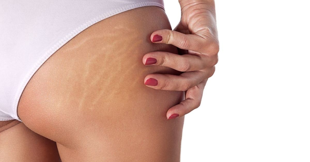 Mengenal Penyebab Stretch Mark dan Cara Efektif Mencegahnya