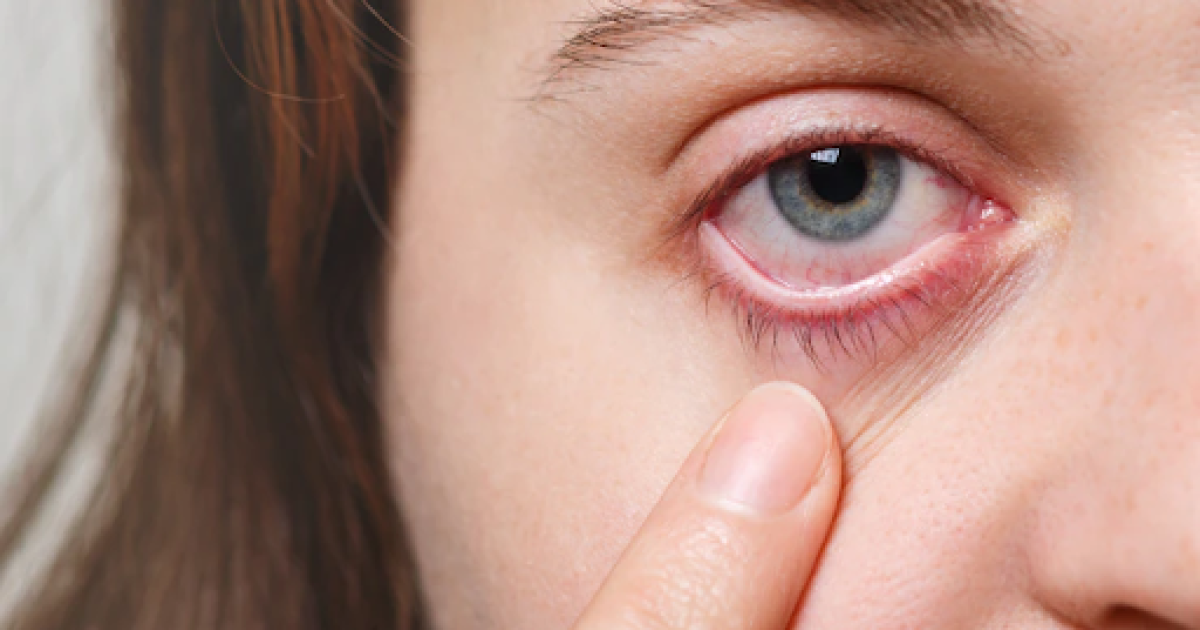 Ancaman Computer Vision Syndrome: Kenali Gejala dan Cara Mencegah Mata Lelah Akibat Layar