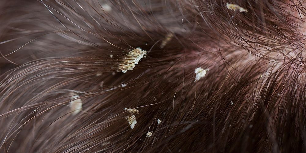 Penyebab dan Cara Ampuh Atasi Rambut Berketombe