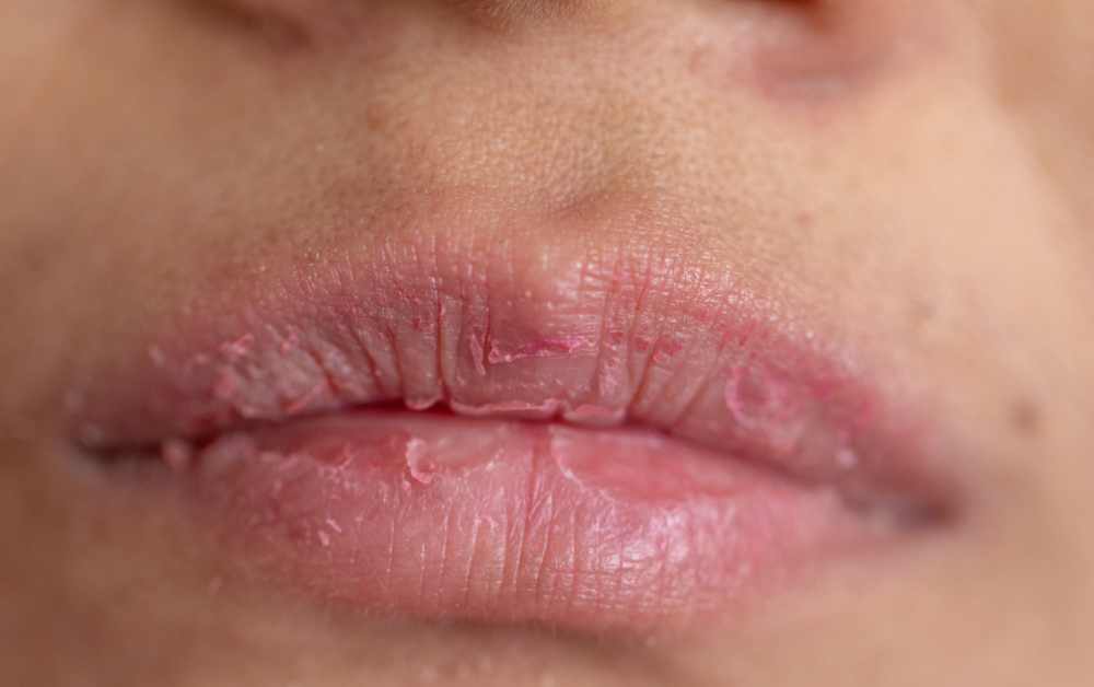 Kenali Penyebab Bibir Kering dan Cara Perawatannya yang Tepat