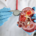 Cara Membesihkan Ginjal atau Detox Secara Alami