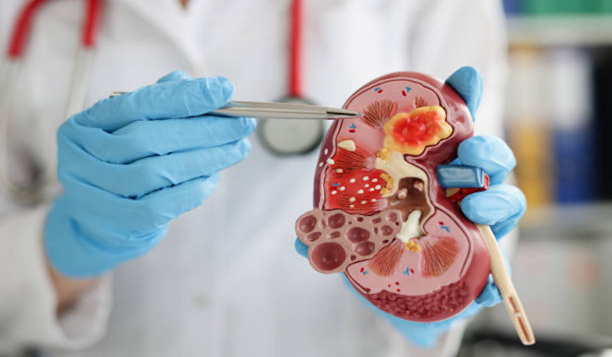 Cara Membesihkan Ginjal atau Detox Secara Alami