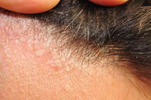 Kulit Kepala Gatal Berlebih Waspadai Tanda Dermatitis Seboroik