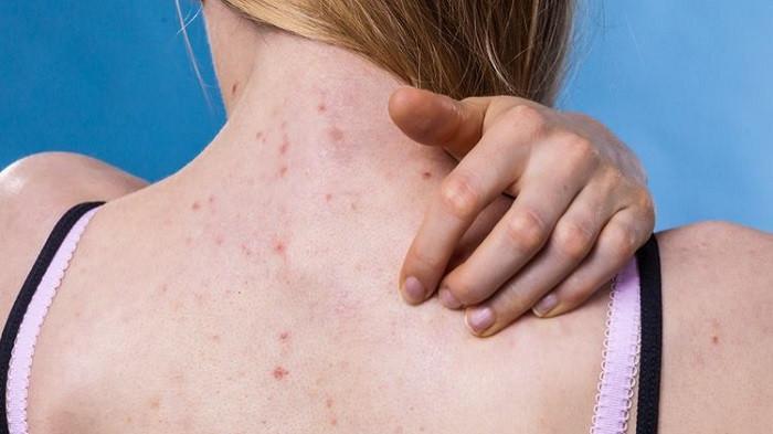 5 Cara Menghilangkan Bekas Jerawat di Punggung