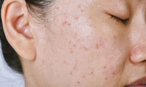 Mengenal Penyakit Langka, dari Sindrom Adams-Oliver hingga Xeroderma Pigmentosum