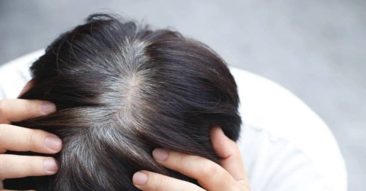 Faktor Penyebab Uban: Stres, Gaya Hidup, hingga Kekurangan Vitamin
