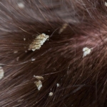 Penyebab dan Cara Ampuh Atasi Rambut Berketombe