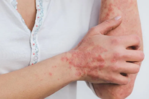 10 Jenis Penyakit Jamur dalam Tubuh Manusia yang Wajib Diwaspadai