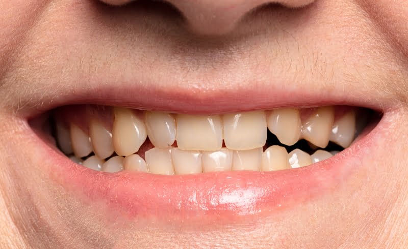 Perbedaan Gigi Susu dan Gigi Permanen: Mulai dari Jumlah hingga Fungsinya