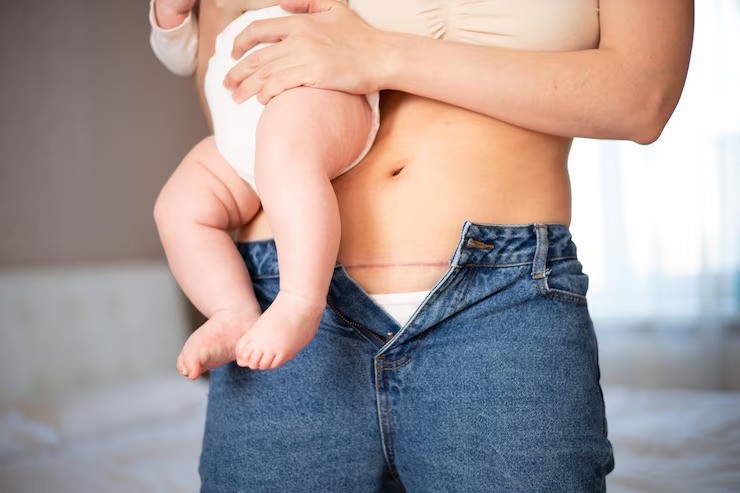 Cara Merawat dan Mengeringkan Bekas Operasi Caesar dengan Aman