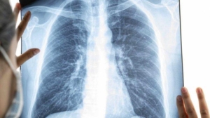 Pneumonia Bisa Sembuh atau Tidak? Kenali Gejala, Risiko, dan Cara Mengobatinya