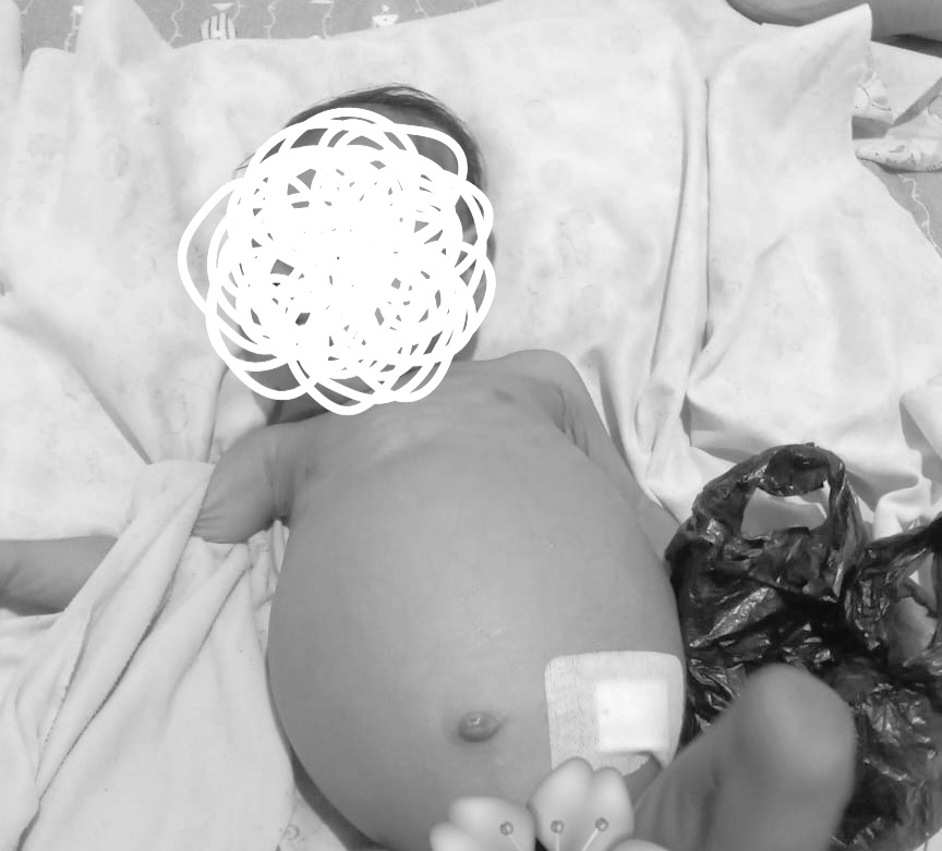 Orang Tua di Bogor Berjuang Selamatkan Bayi Pengidap Atresia Bilier